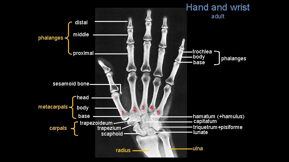 Hand wrist adult distal phalanges middle trochlea body base proximal phalanges sesamoid bone head