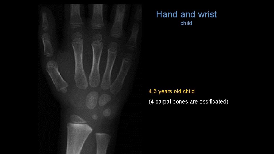 Hand wrist child 4, 5 years old child (4 carpal bones are ossificated) 