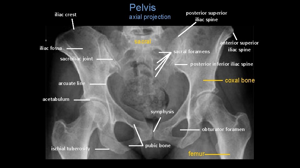 iliac crest iliac fossa Pelvis posterior superior axial projection iliac spine sacral foramens sacroiliac