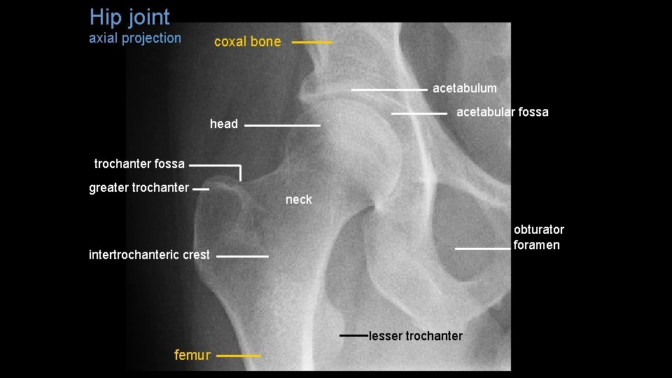 Hip joint axial projection coxal bone acetabulum acetabular fossa head trochanter fossa greater trochanter