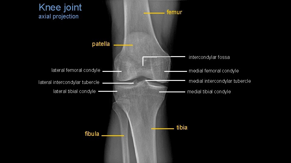 Knee joint femur axial projection patella intercondylar fossa lateral femoral condyle medial intercondylar tubercle