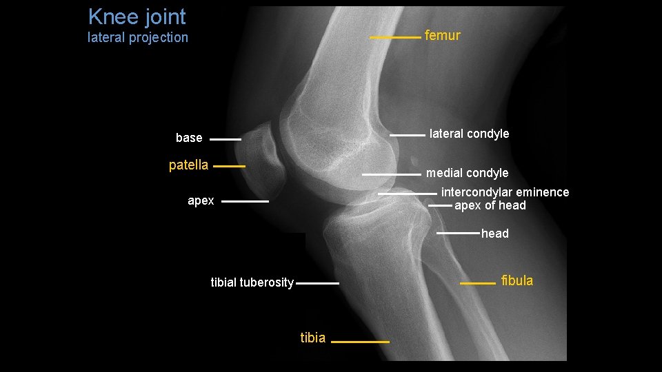 Knee joint femur lateral projection lateral condyle base patella medial condyle intercondylar eminence apex