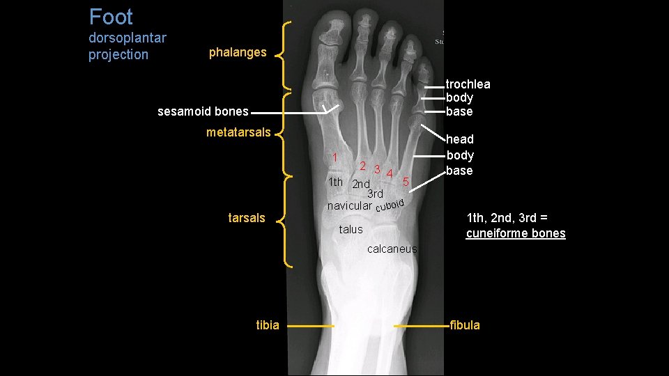 Foot dorsoplantar projection phalanges trochlea body base sesamoid bones metatarsals 1 tarsals 2 3