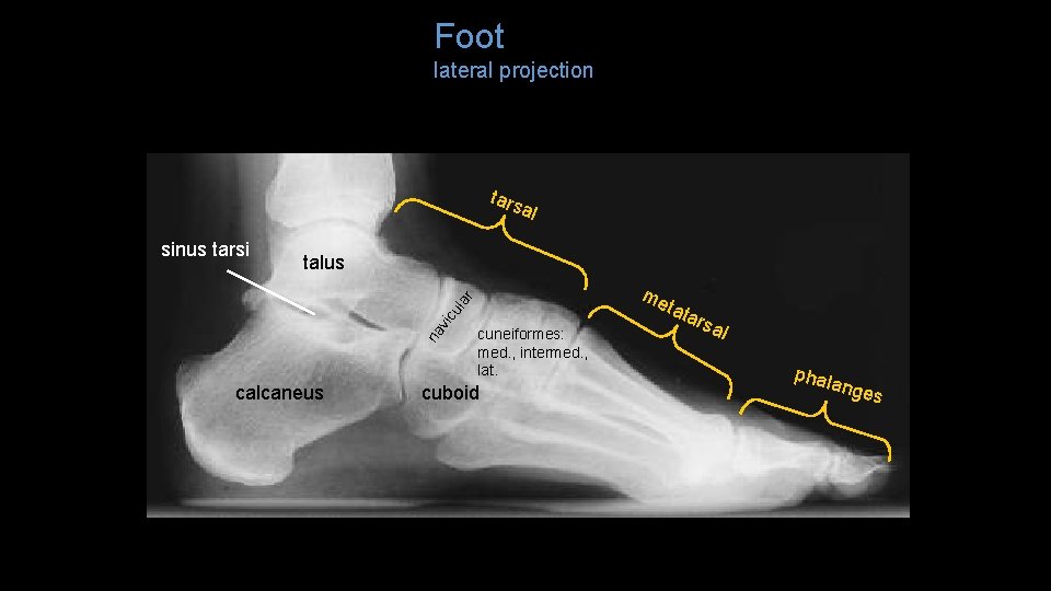 Foot lateral projection tars al talus me na vic ula r sinus tarsi calcaneus