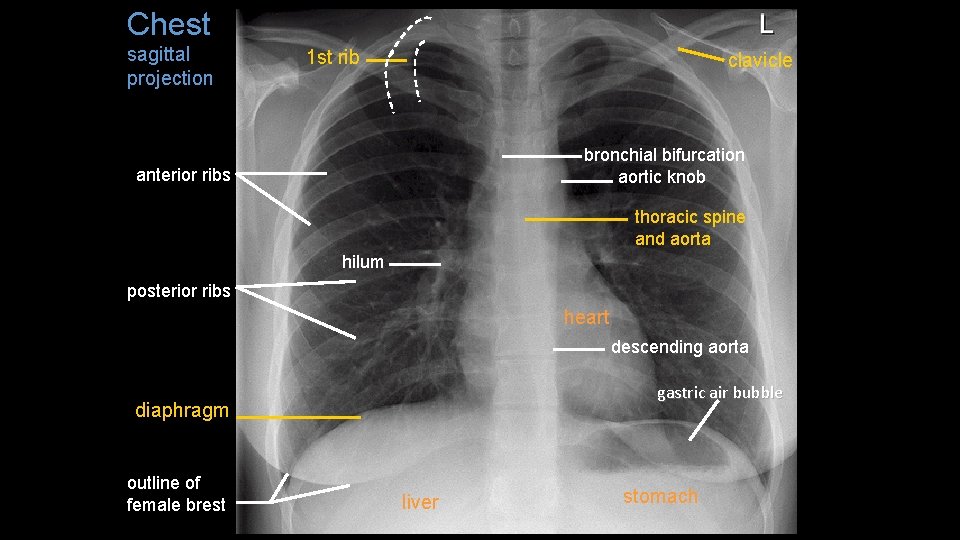 Chest sagittal projection 1 st rib clavicle bronchial bifurcation aortic knob anterior ribs thoracic