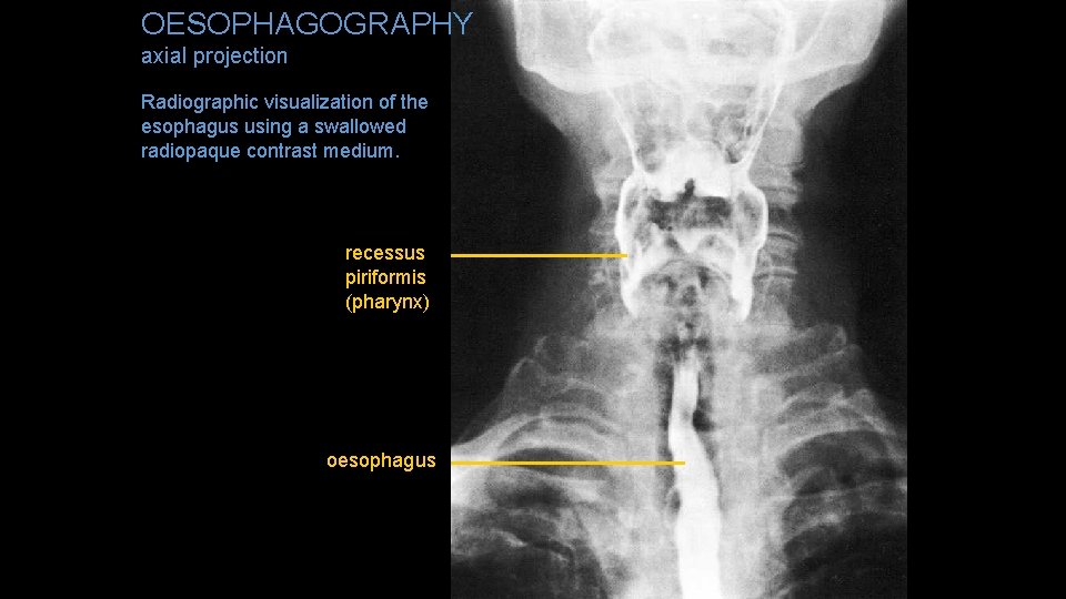 OESOPHAGOGRAPHY axial projection Radiographic visualization of the esophagus using a swallowed radiopaque contrast medium.