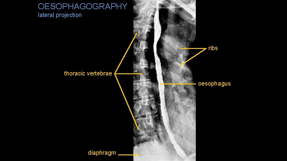 OESOPHAGOGRAPHY lateral projection ribs thoracic vertebrae oesophagus diaphragm 