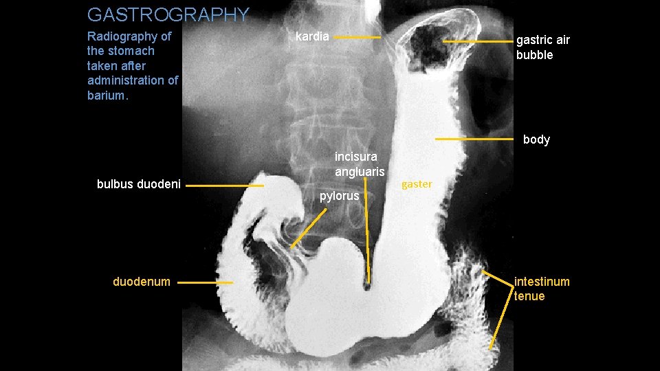 GASTROGRAPHY Radiography of the stomach taken after administration of barium. kardia gastric air bubble