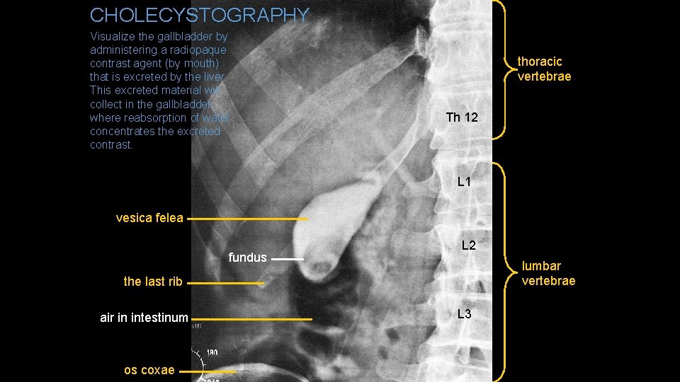 CHOLECYSTOGRAPHY Visualize the gallbladder by administering a radiopaque contrast agent (by mouth) that is