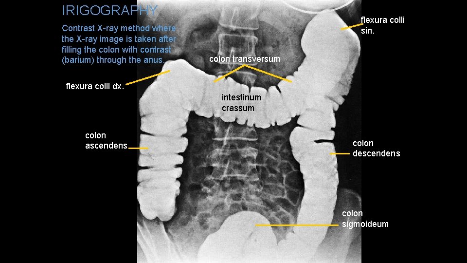 IRIGOGRAPHY Contrast X-ray method where the X-ray image is taken after filling the colon