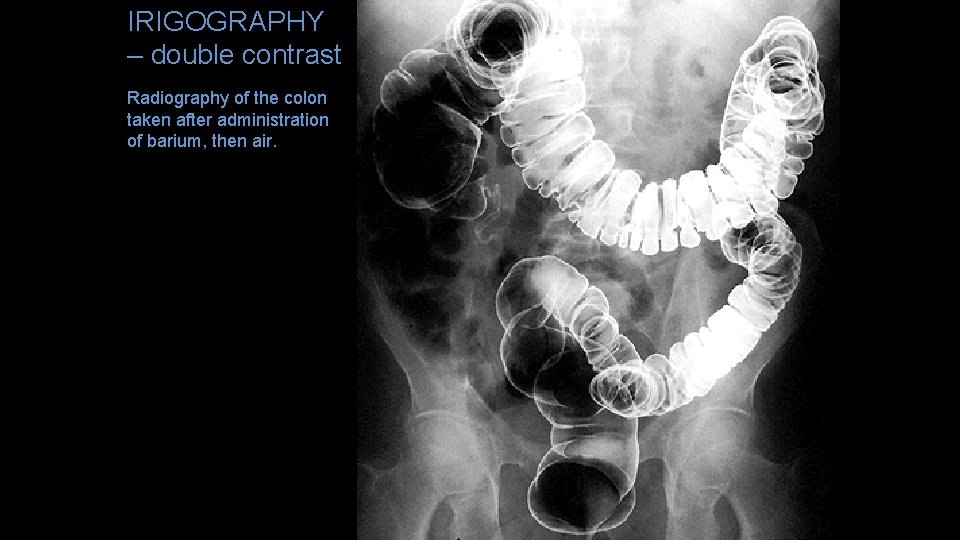 IRIGOGRAPHY – double contrast Radiography of the colon taken after administration of barium, then