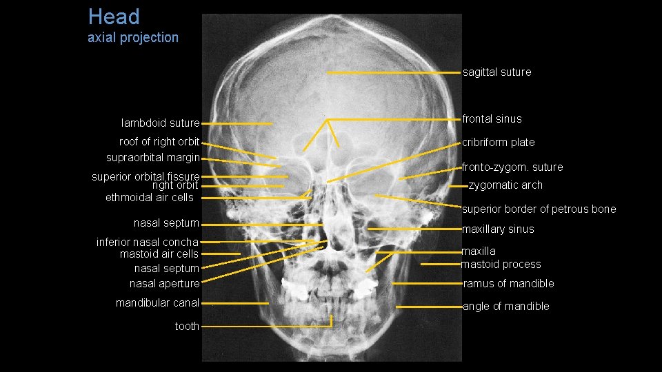 Head axial projection sagittal suture lambdoid suture roof of right orbit supraorbital margin superior