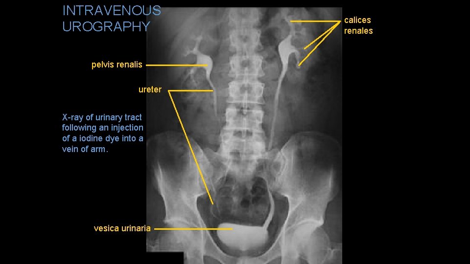 INTRAVENOUS UROGRAPHY pelvis renalis ureter X-ray of urinary tract following an injection of a