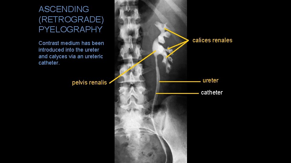 ASCENDING (RETROGRADE) PYELOGRAPHY Contrast medium has been introduced into the ureter and calyces via