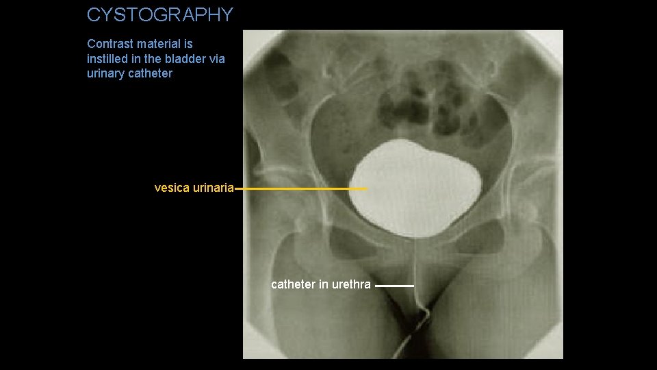 CYSTOGRAPHY Contrast material is instilled in the bladder via urinary catheter vesica urinaria catheter
