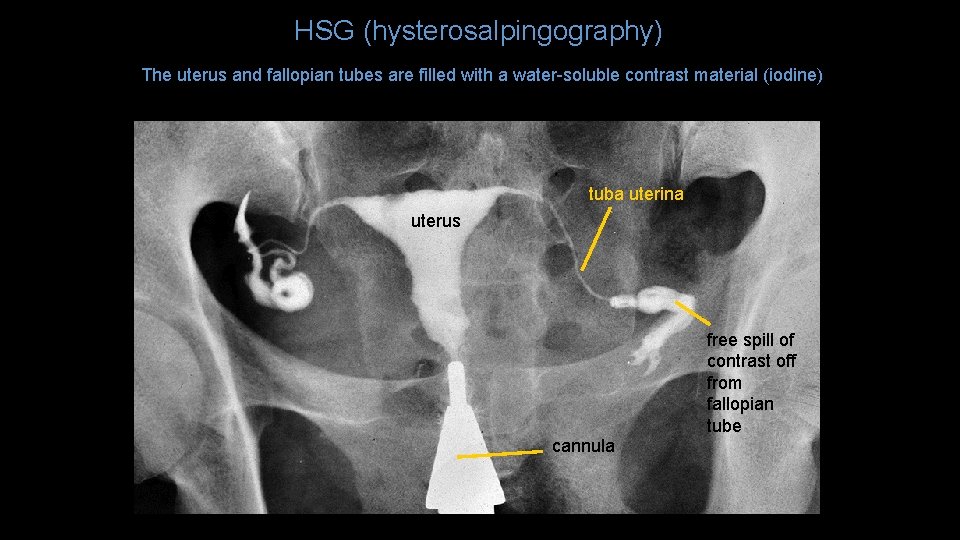 HSG (hysterosalpingography) The uterus and fallopian tubes are filled with a water-soluble contrast material
