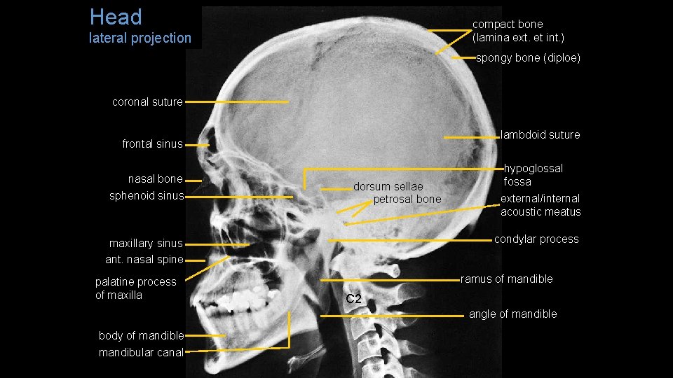 Head compact bone (lamina ext. et int. ) lateral projection spongy bone (diploe) coronal