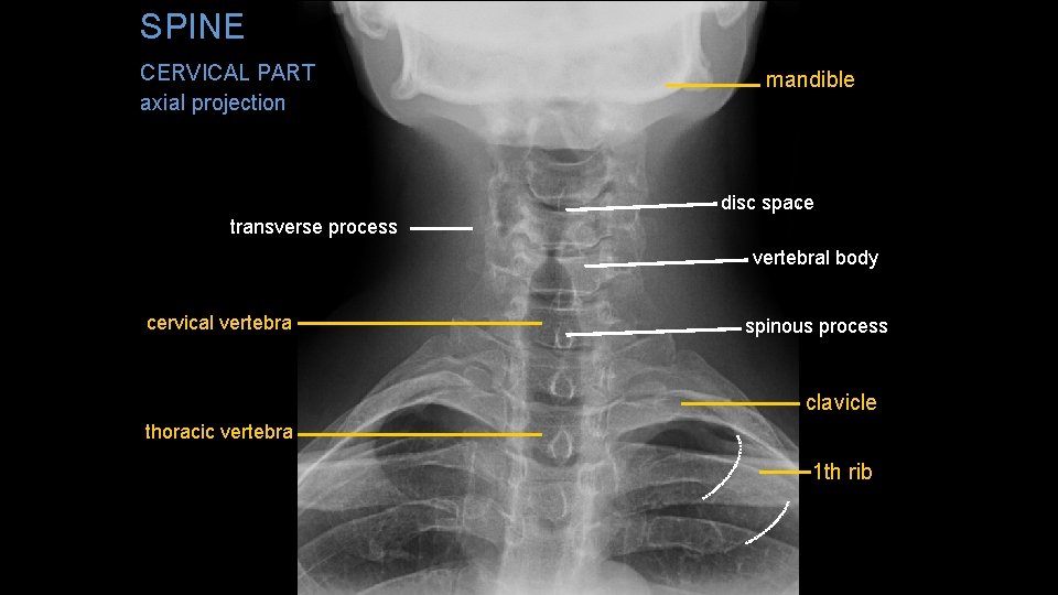 SPINE CERVICAL PART axial projection mandible disc space transverse process vertebral body cervical vertebra