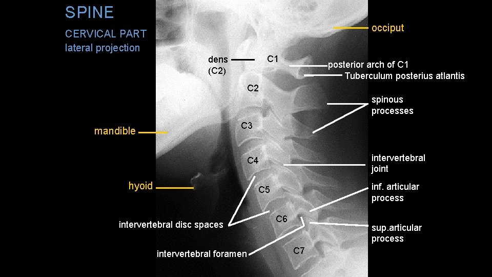 SPINE CERVICAL PART occiput lateral projection C 1 dens (C 2) posterior arch of