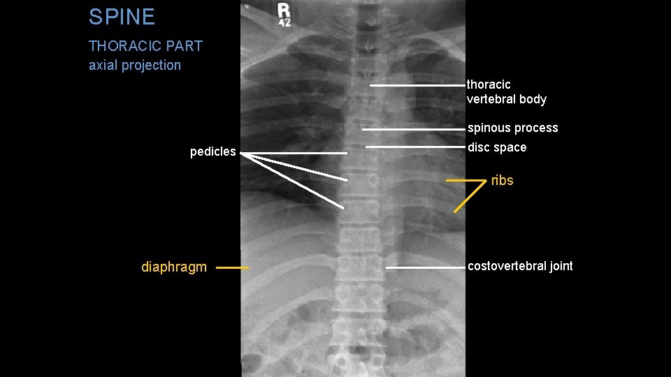 SPINE THORACIC PART axial projection thoracic vertebral body spinous process pedicles disc space ribs
