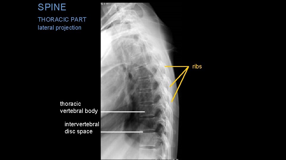 SPINE THORACIC PART lateral projection ribs thoracic vertebral body intervertebral disc space 