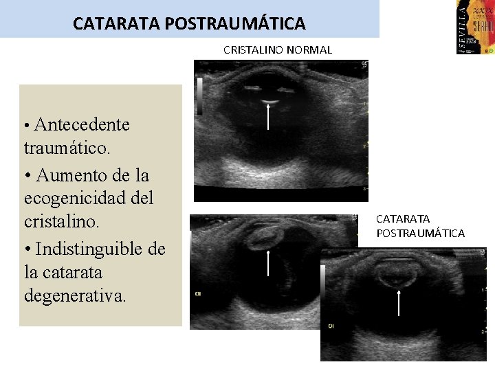 CATARATA POSTRAUMÁTICA CRISTALINO NORMAL • Antecedente traumático. • Aumento de la ecogenicidad del cristalino.