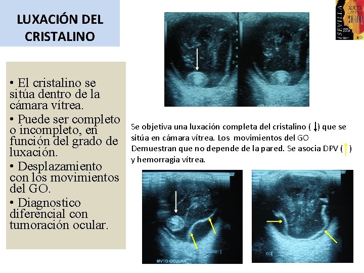 LUXACIÓN DEL CRISTALINO • El cristalino se sitúa dentro de la cámara vítrea. •