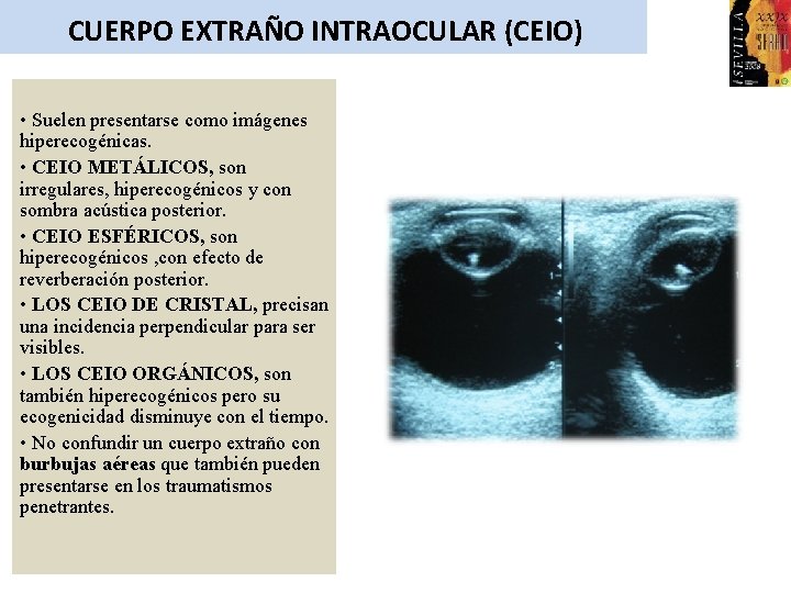 CUERPO EXTRAÑO INTRAOCULAR (CEIO) • Suelen presentarse como imágenes hiperecogénicas. • CEIO METÁLICOS, son