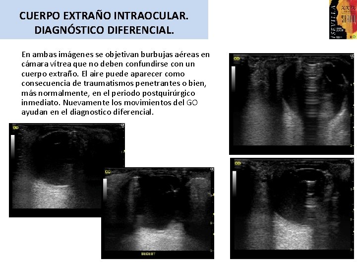 CUERPO EXTRAÑO INTRAOCULAR. DIAGNÓSTICO DIFERENCIAL. En ambas imágenes se objetivan burbujas aéreas en cámara