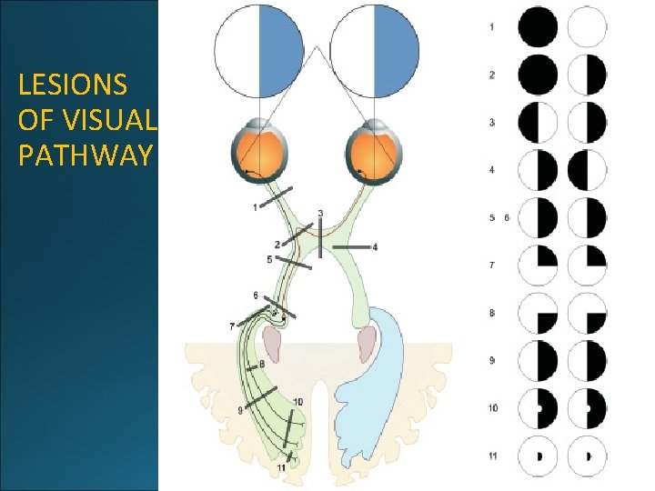 LESIONS OF VISUAL PATHWAY 