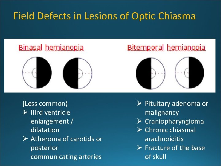 Field Defects in Lesions of Optic Chiasma (Less common) Ø IIIrd ventricle enlargement /