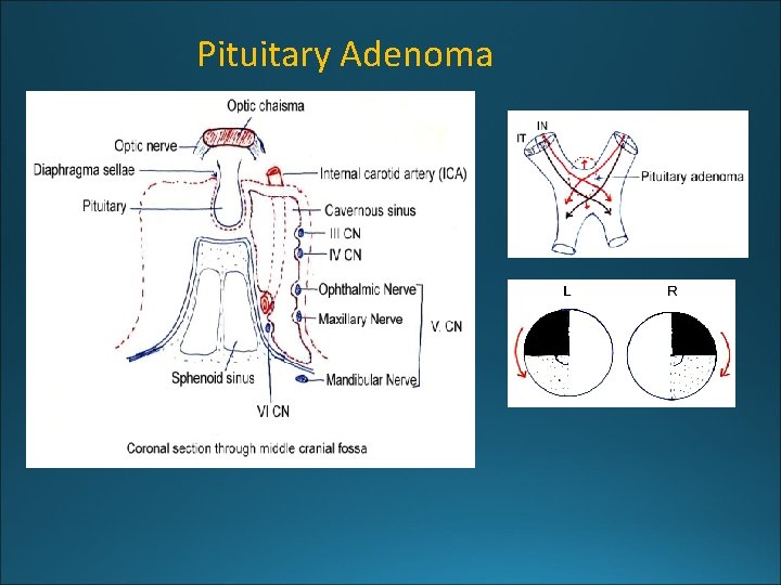 Pituitary Adenoma 