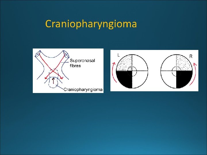 Craniopharyngioma 