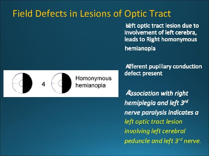 Field Defects in Lesions of Optic Tract left optic tract lesion involving left cerebral