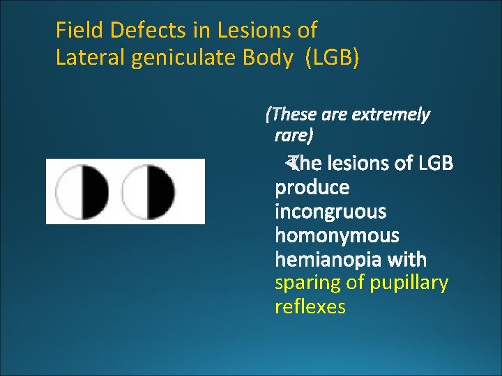 Field Defects in Lesions of Lateral geniculate Body (LGB) sparing of pupillary reflexes 