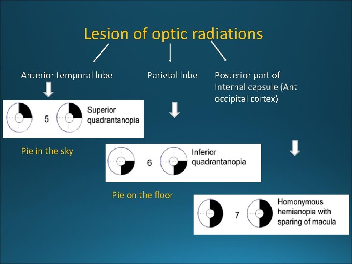 Lesion of optic radiations Anterior temporal lobe Parietal lobe Pie in the sky Pie