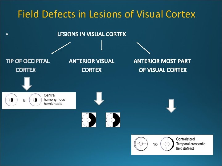 Field Defects in Lesions of Visual Cortex 