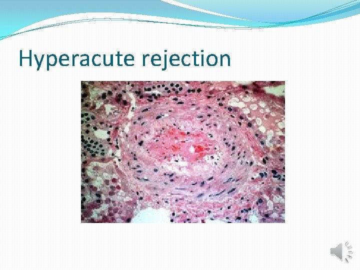 Hyperacute rejection 