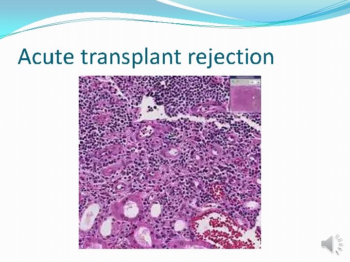 Acute transplant rejection 