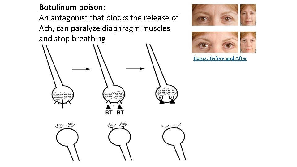 Botulinum poison: An antagonist that blocks the release of Ach, can paralyze diaphragm muscles