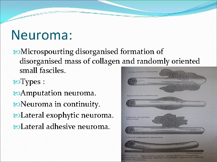 Neuroma: Microspourting disorganised formation of disorganised mass of collagen and randomly oriented small fasciles.