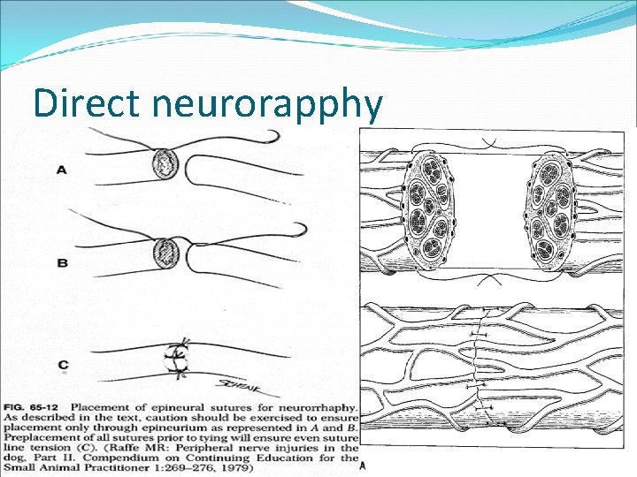 Direct neurorapphy Epineural sutures. No perineural sutures. 7 -0, 9 -0 nonabsorbable sutures. No