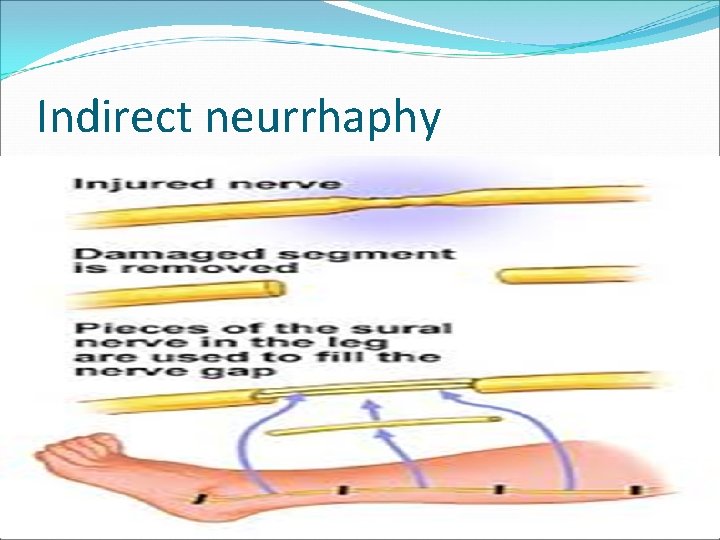 Indirect neurrhaphy Tension , nerve gap exists in direct neurrhaphy procedure. Grafting is considered.