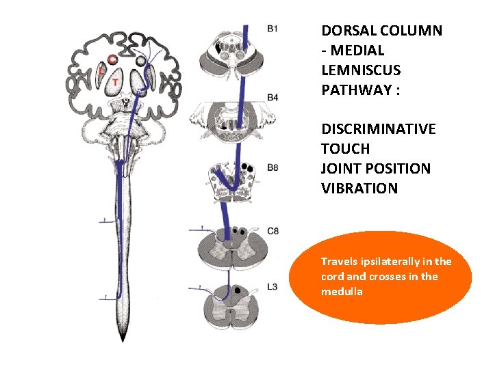 DORSAL COLUMN - MEDIAL LEMNISCUS PATHWAY : DISCRIMINATIVE TOUCH JOINT POSITION VIBRATION Travels ipsilaterally