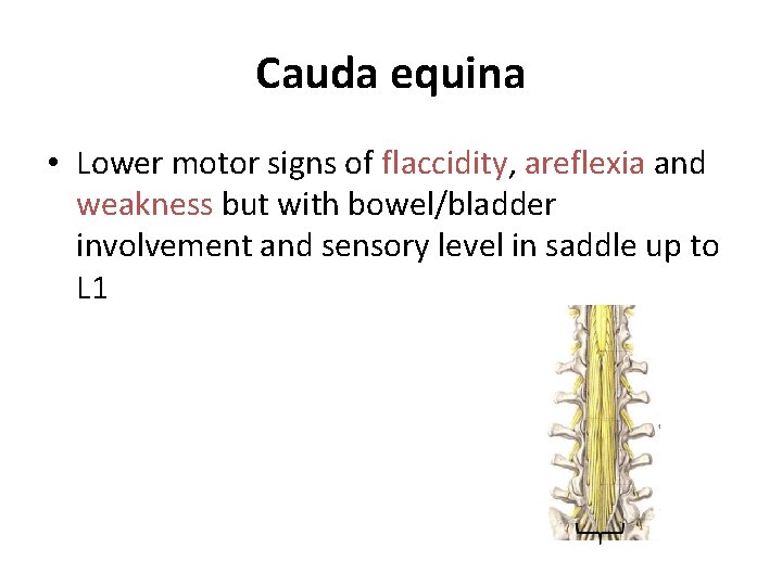 Cauda equina • Lower motor signs of flaccidity, areflexia and weakness but with bowel/bladder