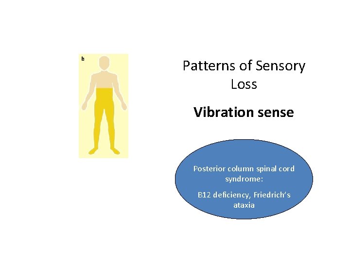 Patterns of Sensory Loss Vibration sense Posterior column spinal cord syndrome: B 12 deficiency,