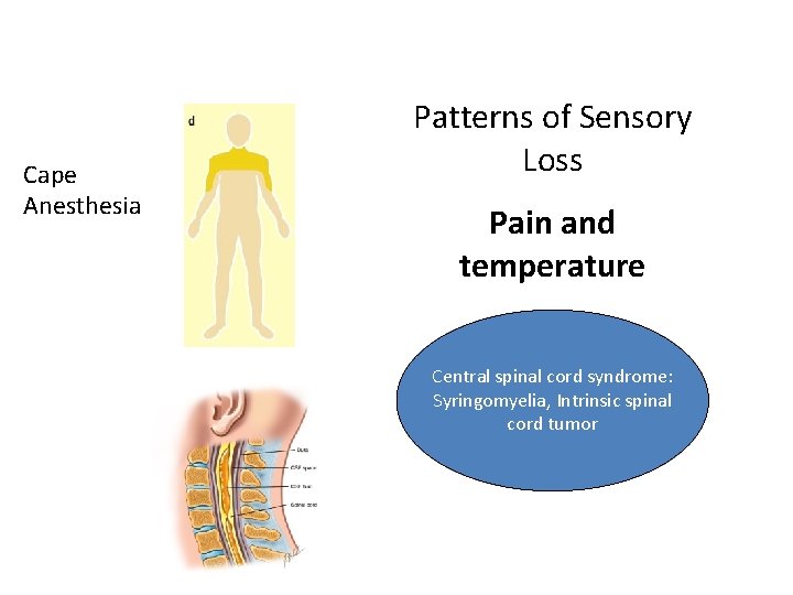 Cape Anesthesia Patterns of Sensory Loss Pain and temperature Central spinal cord syndrome: Syringomyelia,