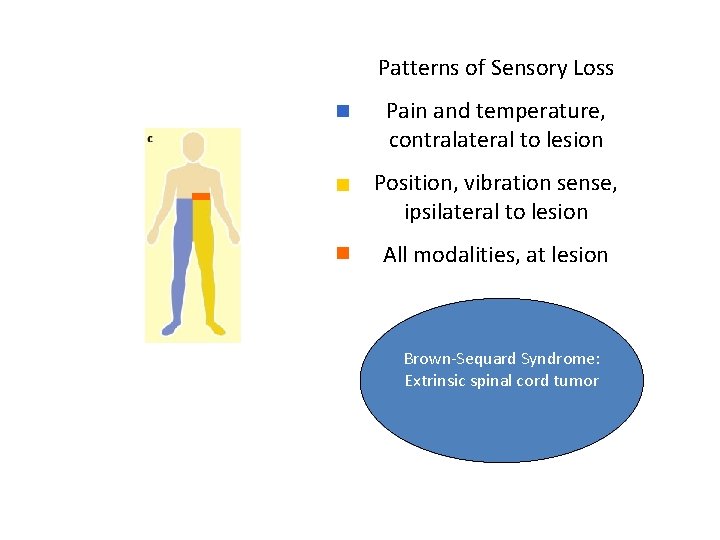 Patterns of Sensory Loss Pain and temperature, contralateral to lesion Position, vibration sense, ipsilateral