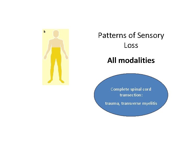 Patterns of Sensory Loss All modalities Complete spinal cord transection: trauma, transverse myelitis 