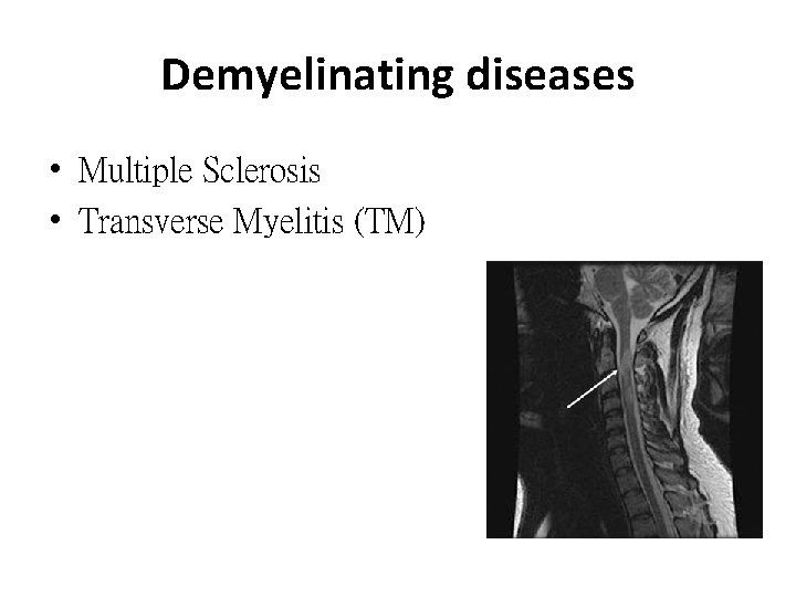 Demyelinating diseases • Multiple Sclerosis • Transverse Myelitis (TM) 